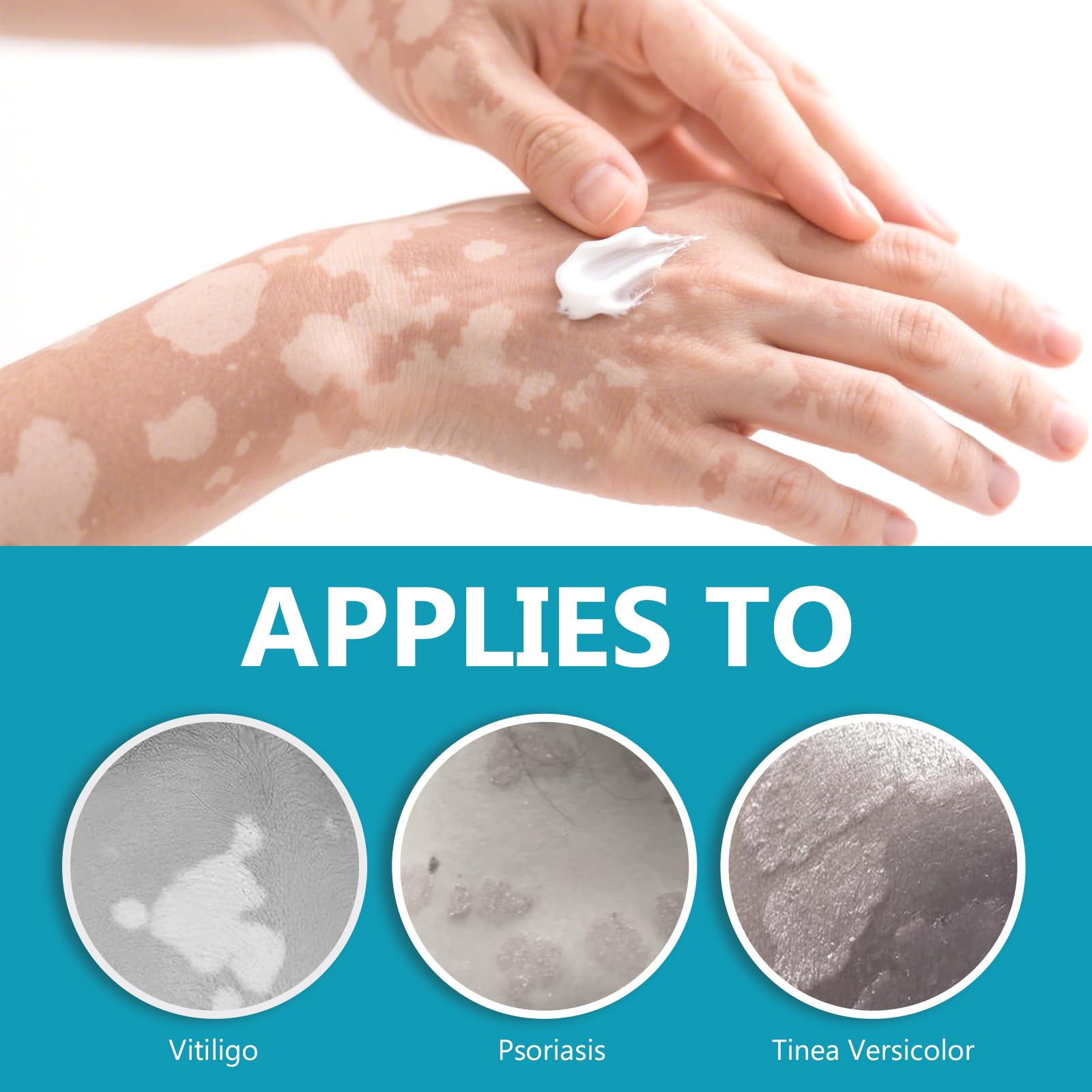 TDZLDM Vitiligo Cream - Natural White Spot Treatment for Face and Body