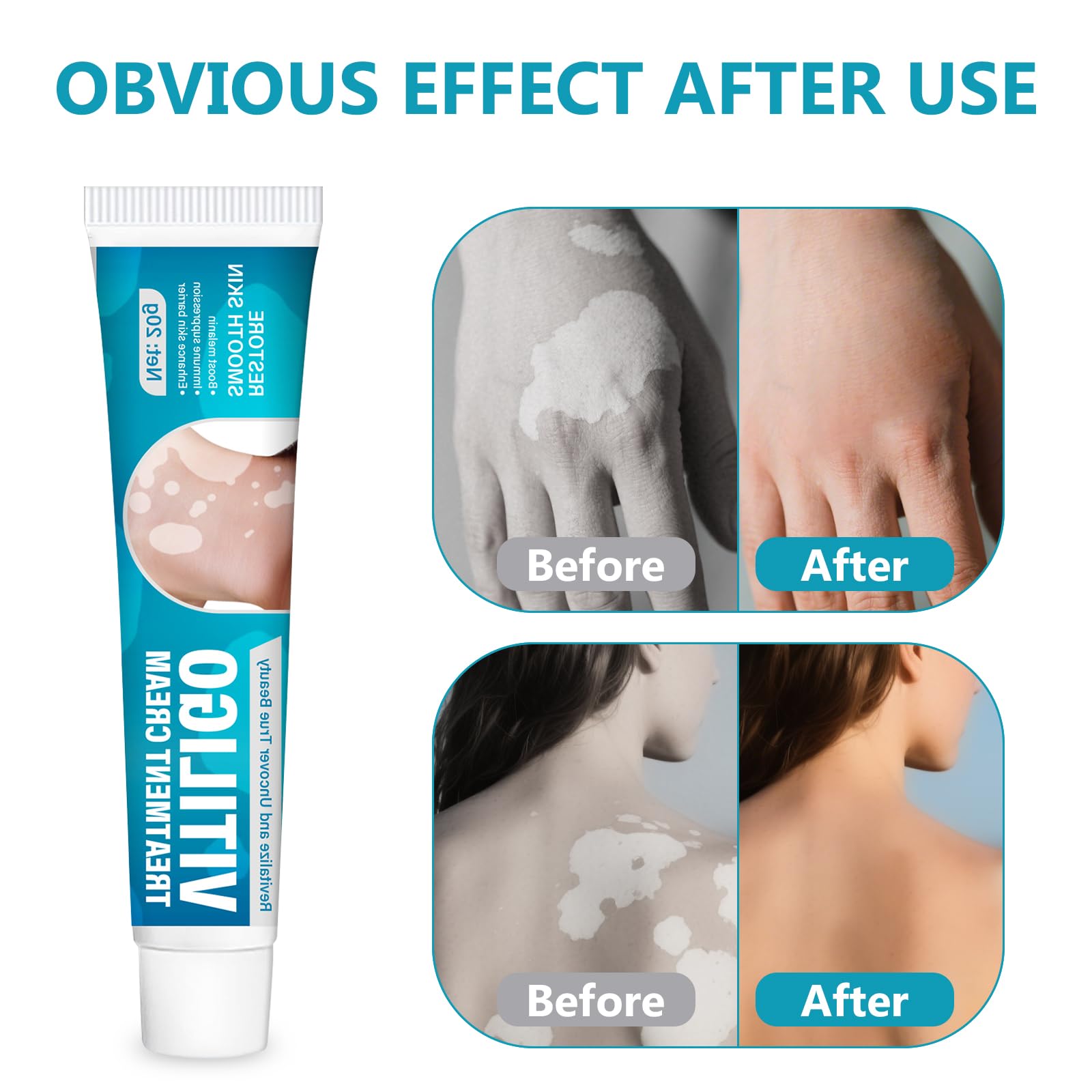 TDZLDM Vitiligo Cream - Natural White Spot Treatment for Face and Body