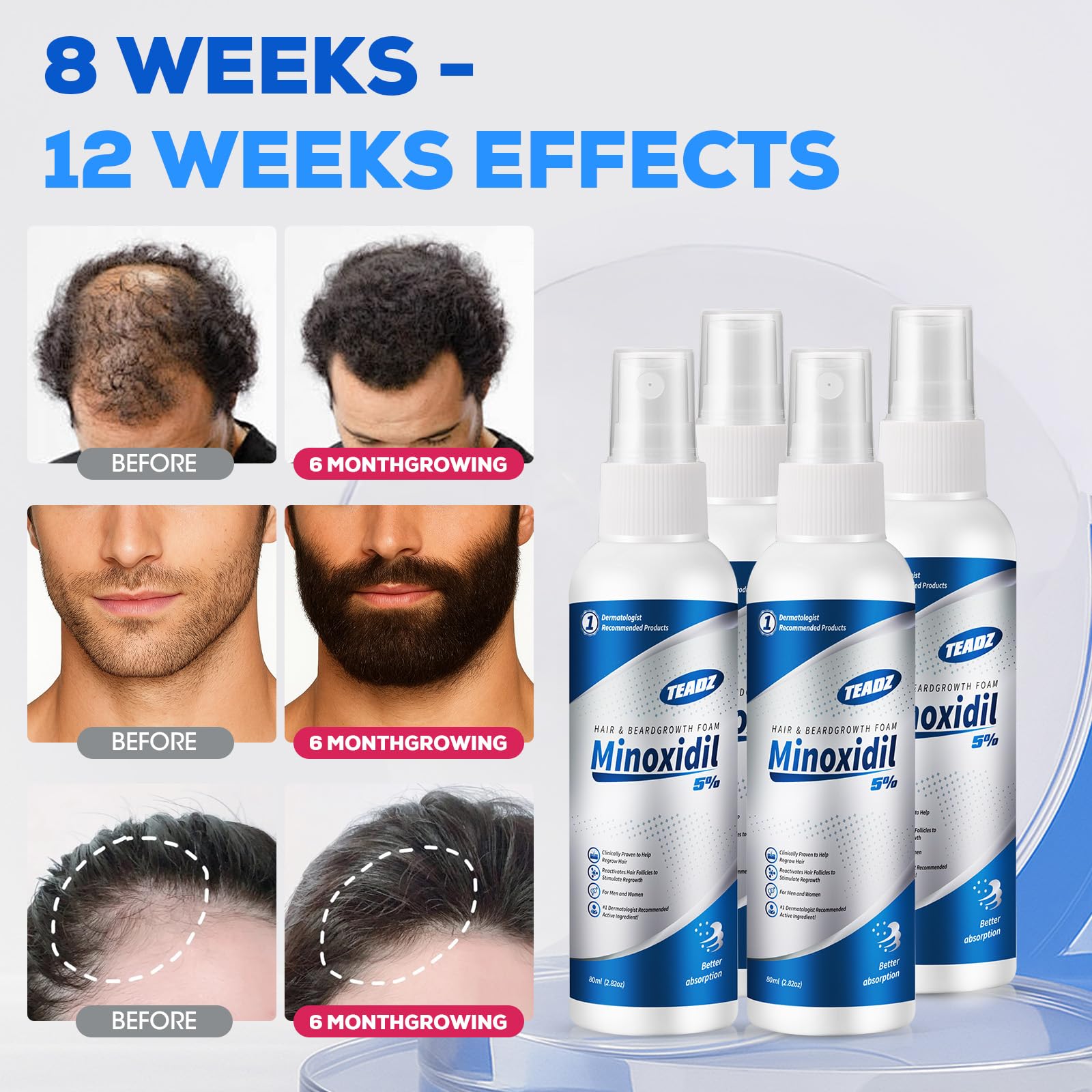 TEADZ 5% Minoxidil for Men & Women – Intense Hair Growth Serum (4 x 2.82 oz)