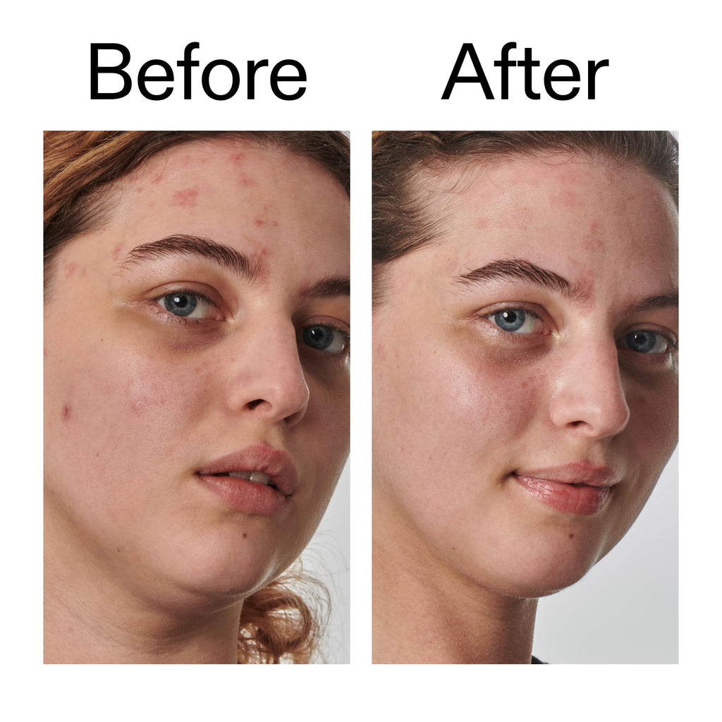 The INKEY List SuperSolutions Urea 10% Moisturizer – Hydration, Gentle Exfoliation & Soothe Dry Skin