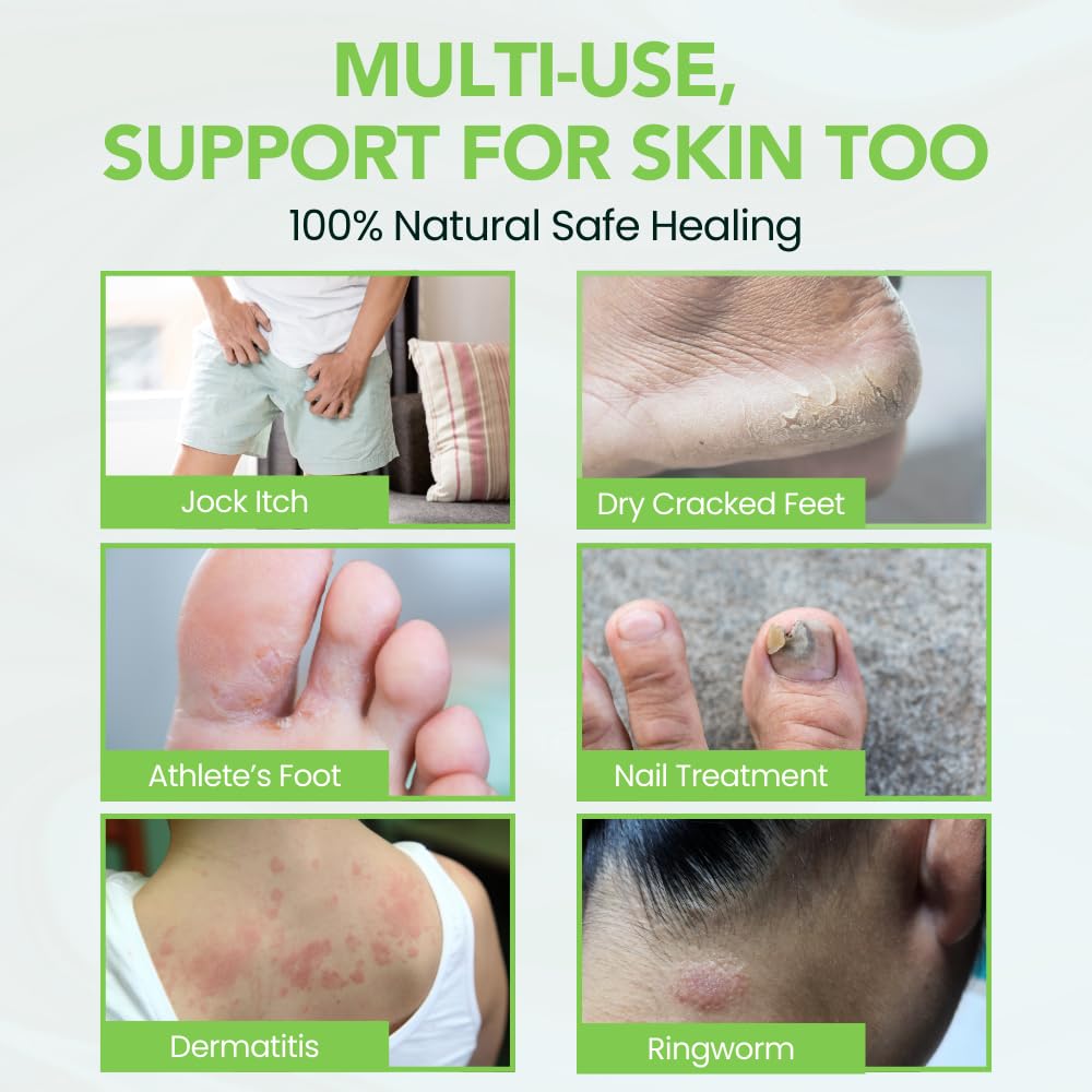 Thena Athletes Foot Cream Extra Strength Herbal Relief – Tea Tree, Neem & Menthol | THENA Natural Wellness