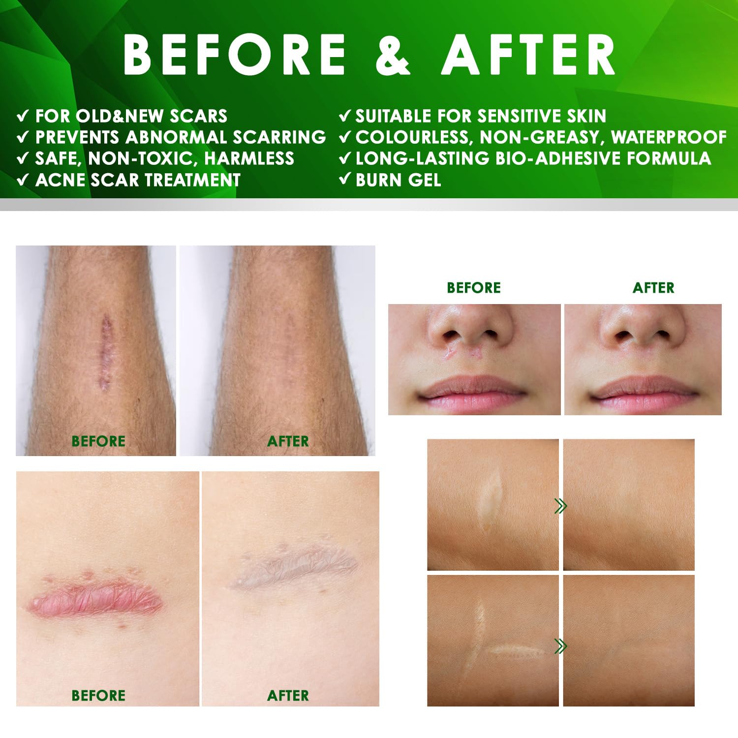 Tobcharm Advanced Keloid Scar Gel – Silicone Scar Care, 2-Pack (30g x2)