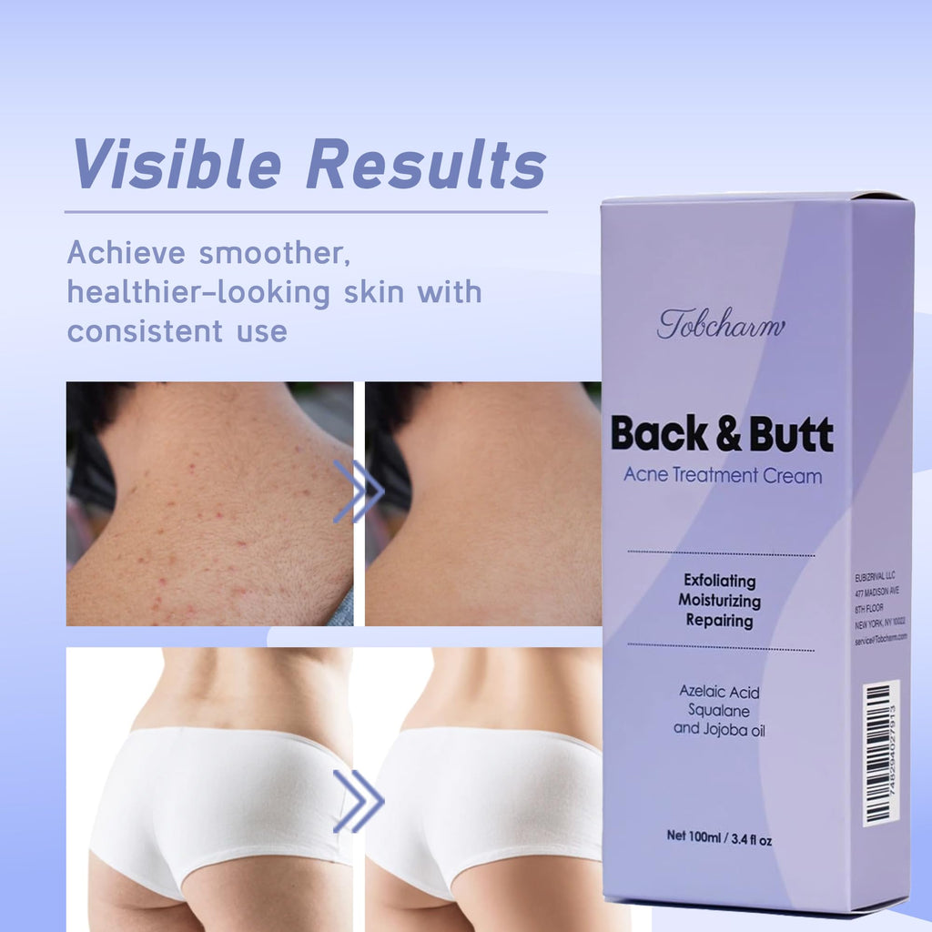 Tobcharm Butt Acne Clearing Treatment – Maximum Strength Body Cream for Back, Butt, Thigh & Chest
