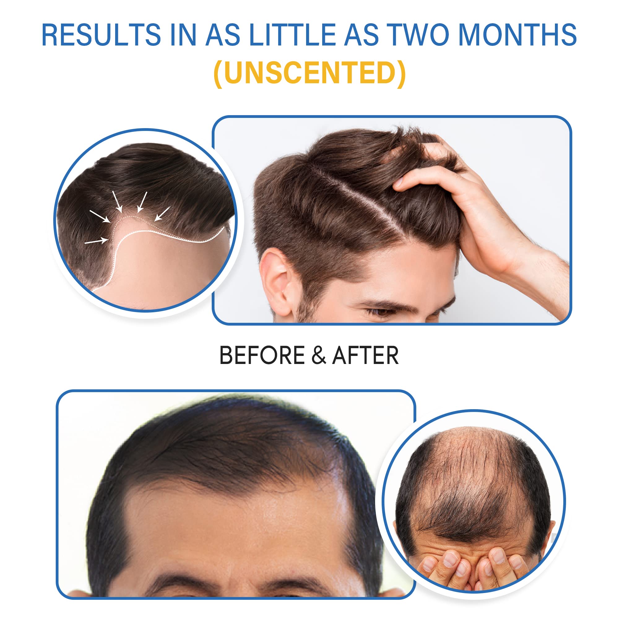 Tomum 5% Minoxidil Foam for Hair Regrowth – Fast-Absorbing, Non-Greasy, For Men & Women