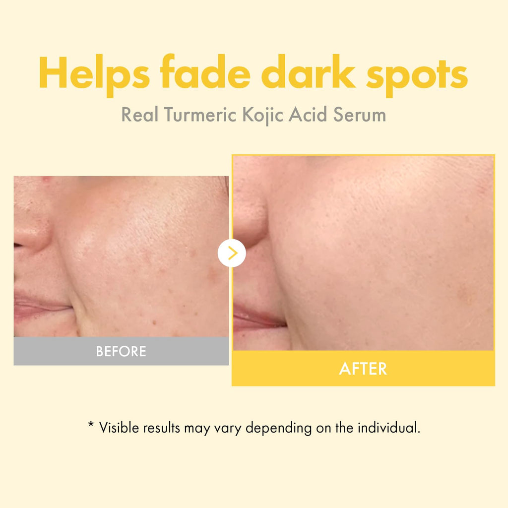 TOSOWOONG Real Turmeric Kojic Acid Serum – Brightening Serum with 7,000ppm Kojic Acid, 1,500ppm Turmeric, 33ml
