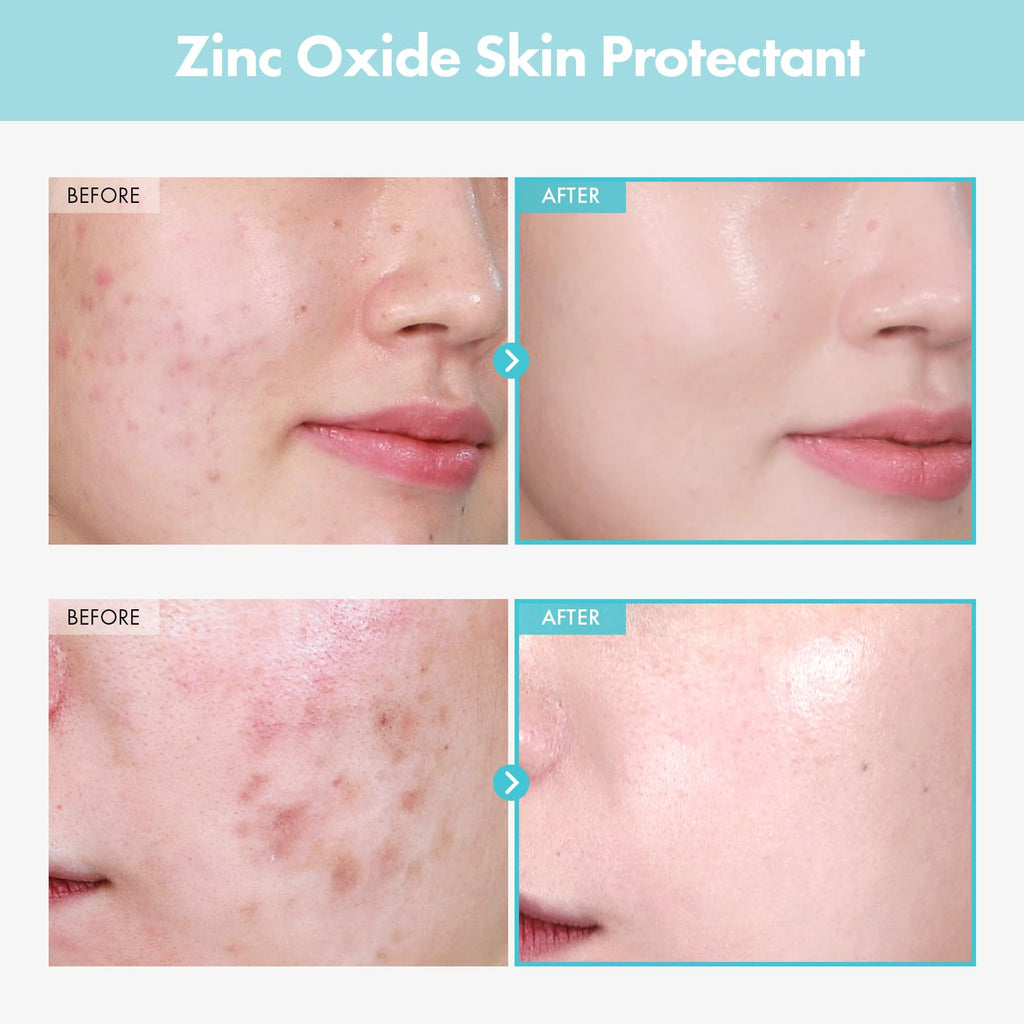 TOSOWOONG SOS Repair CICA Clinic Zinc Cream 50g – 10% Zinc Oxide for Barrier Repair & Soothing