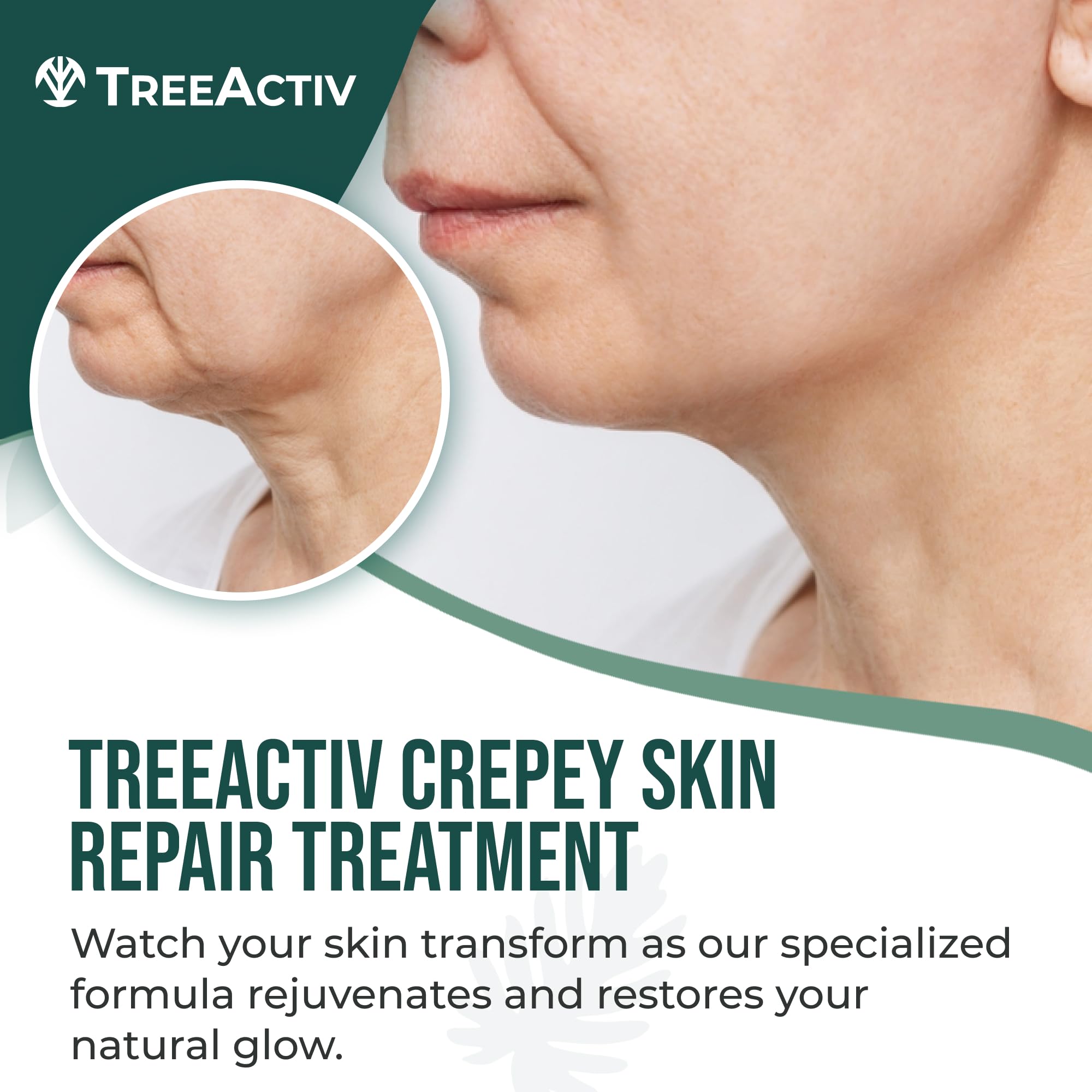 TreeActiv Crepey Skin Repair Cream – Firming Hyaluronic Acid Lotion (8 oz)