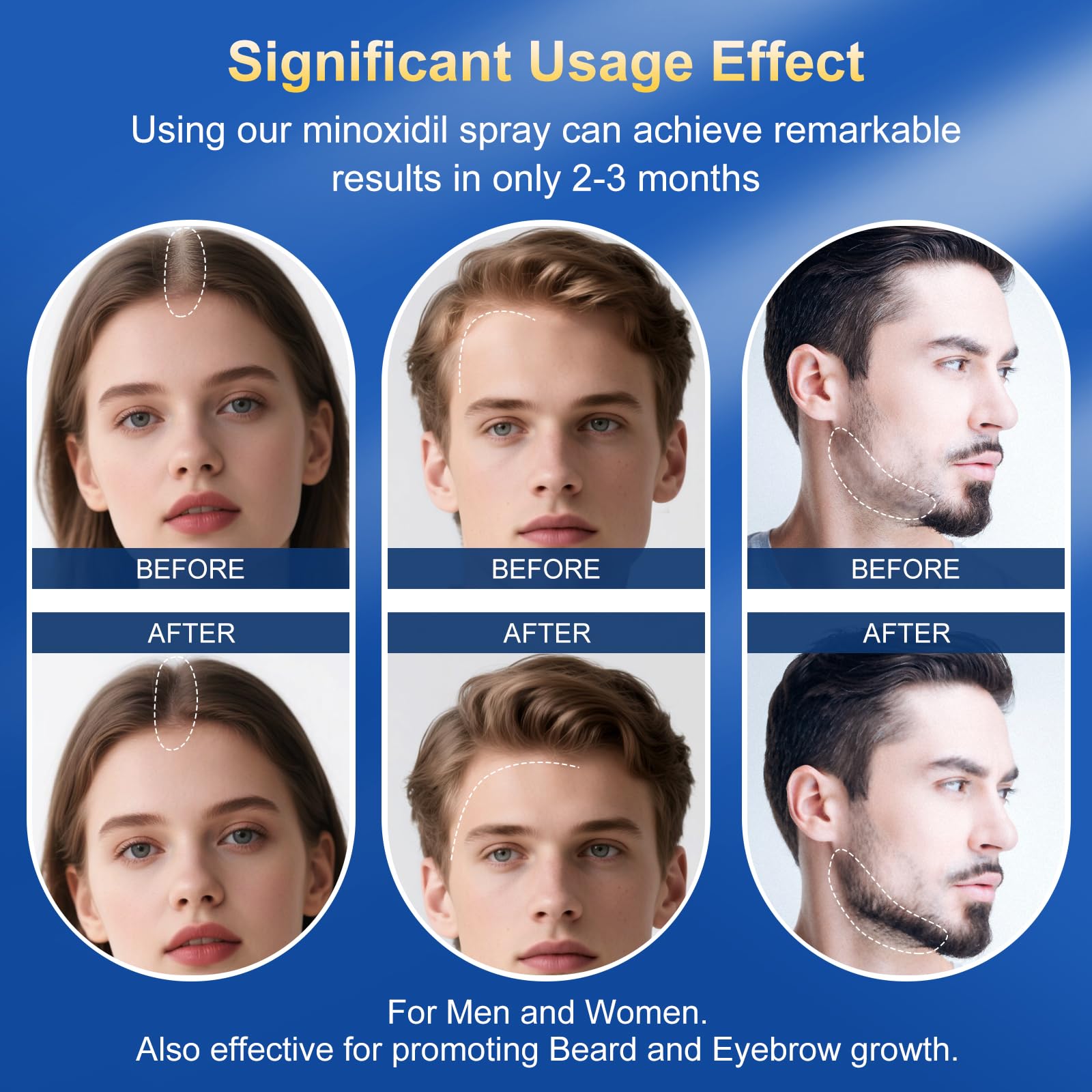 Trzsfr 5% Minoxidil for Men & Women – Hair Growth Serum & Beard Growth | 4-Pack 14 fl oz Biotin
