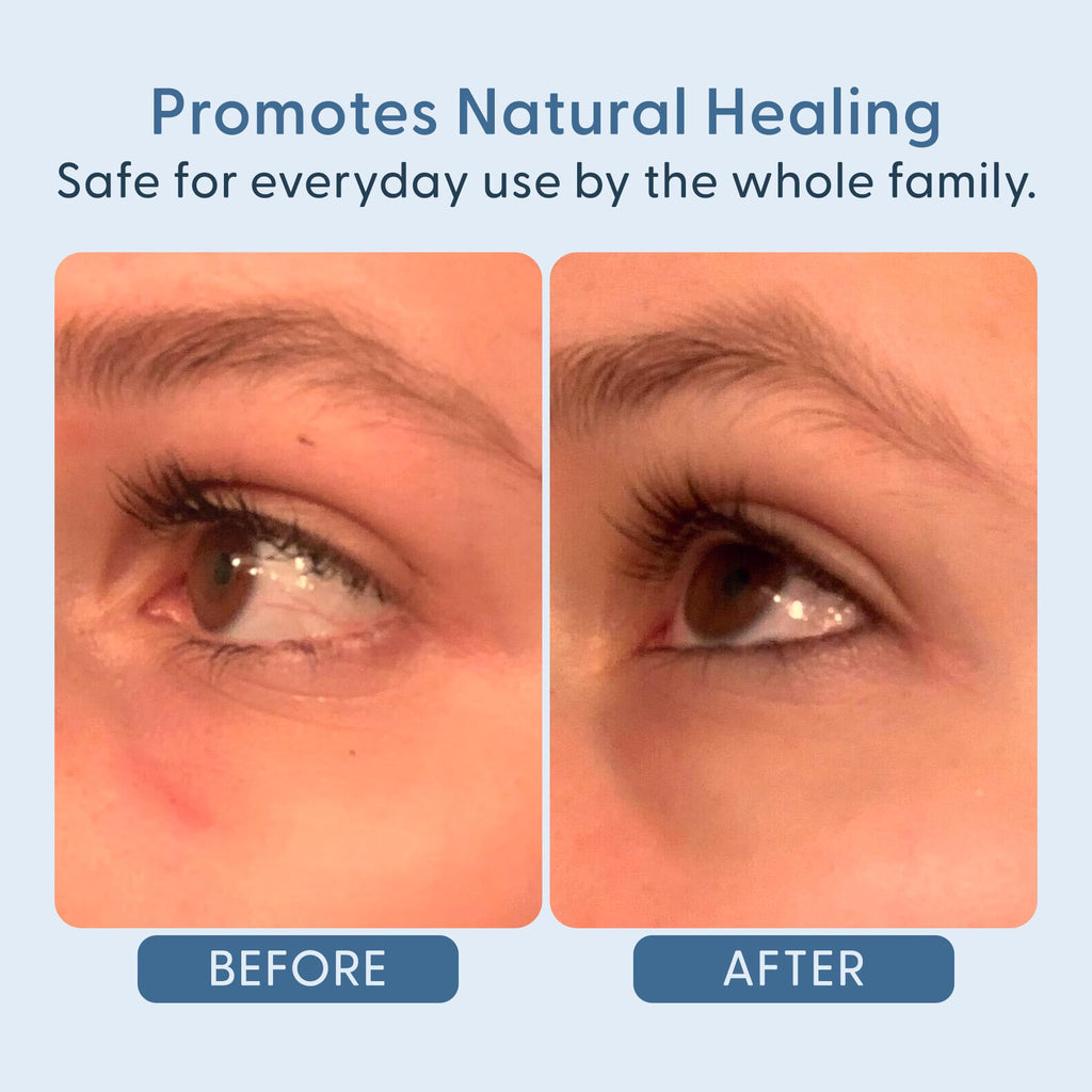 twenty/twenty Easy On The Eyes – 0.02% Hypochlorous Acid Spray for Eyelashes | Safe for Sensitive Skin | Ophthalmologist Developed – 60ml