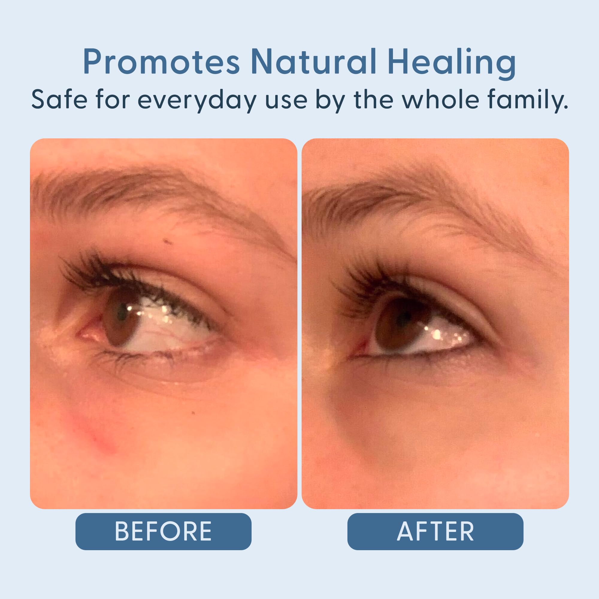 twenty/twenty Easy On The Eyes – 0.02% Hypochlorous Acid Spray for Eyelashes | Safe for Sensitive Skin | Ophthalmologist Developed – 60ml