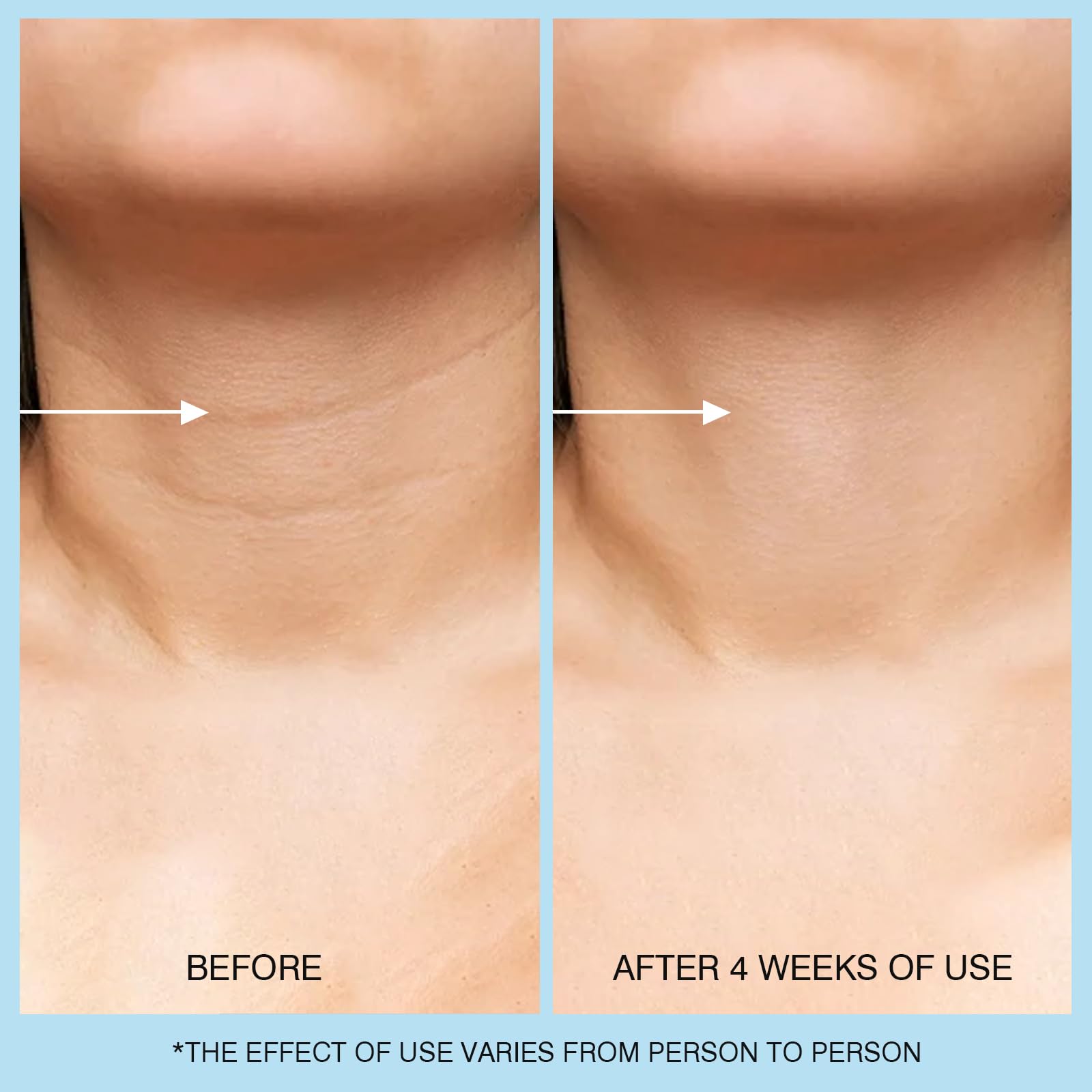 UJhay Retinol Neck Cream with Hyaluronic Acid & Caffeine – 3-in-1 Firming for Neck, Face & Chest (50 ml)