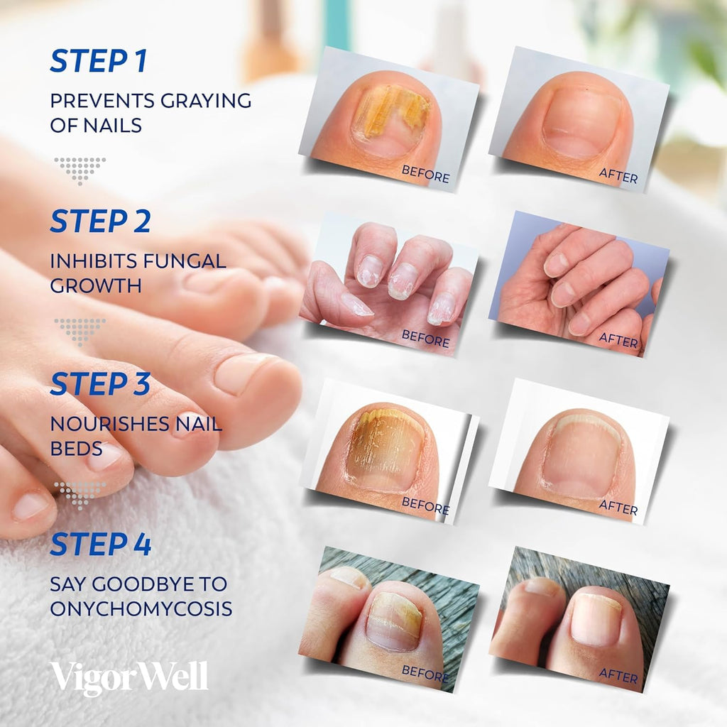 VigorWell Toenail Fungus Treatment Extra Strength – Nighttime Patches & 15ml Nail Repair Liquid (32 Patches)