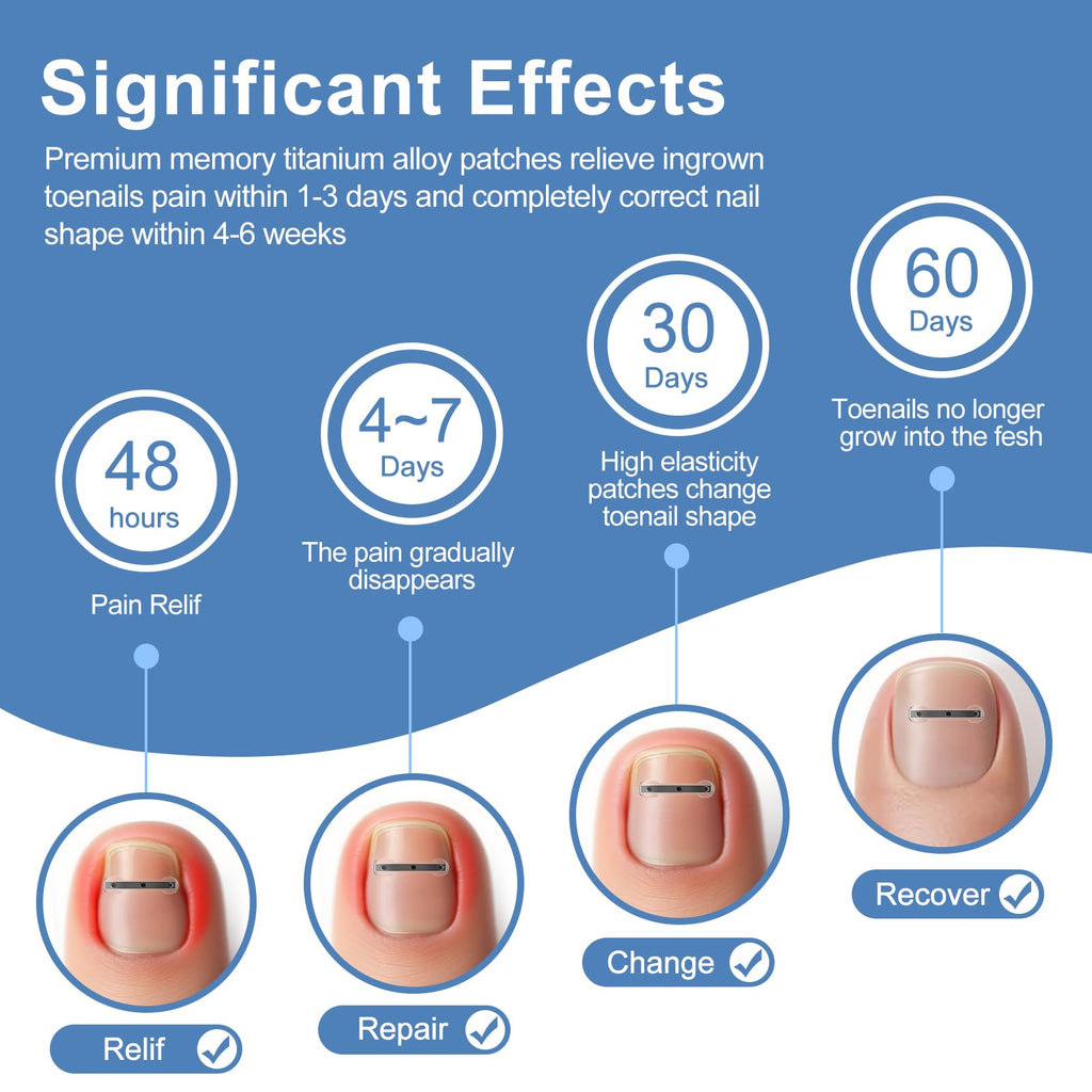 VITASY 12Pcs Ingrown Toenail Corrector Strips – 4 Sizes, Quick Home Relief Kit