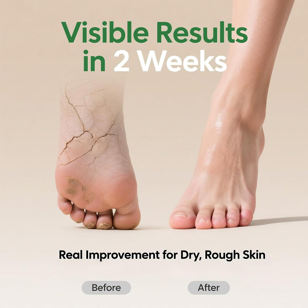 ZyraGloz 60% Urea Cream with 2% Salicylic Acid – Maximum Strength Foot & Hand Moisturizer (10.1 fl oz)
